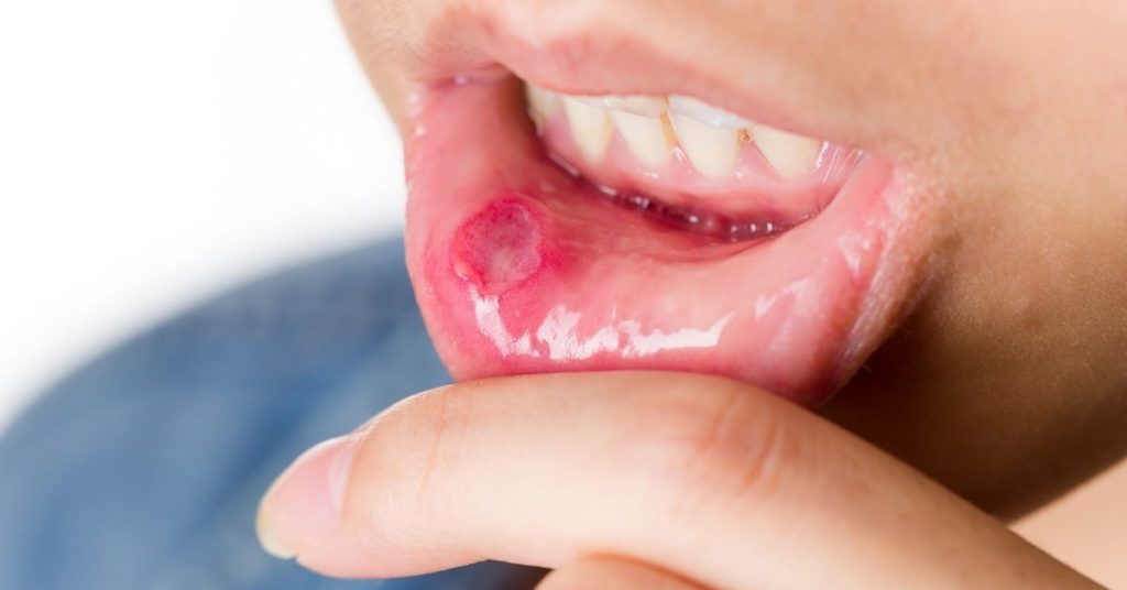 how to treat mouth ulcer 